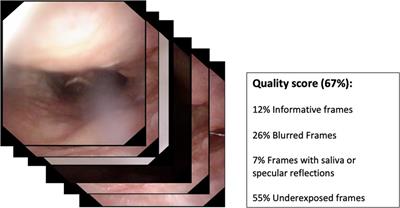 Artificial intelligence in clinical endoscopy: Insights in the field of videomics